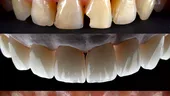 5 mituri despre faţetele dentare, demontate de medicul dentist
