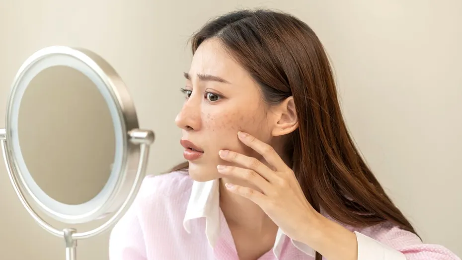 4 alimente care pot agrava acneea, potrivit unui medic dermatolog