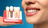 5 preconcepții despre implantul dentar. Ce este adevărat și ce este fals?