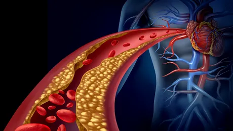 Dislipidemia, un factor major de risc în apariţia bolilor cardiovasculare