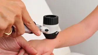 Primul semn al cancerului de piele! La ce să fii atent, ca să-ți crești șansele de vindecare