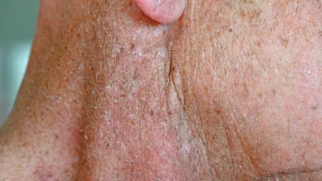 Radiodermita sau dermatita de radiație – cum se tratează pielea afectată de radioterapie prin nanolipofilling