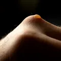 De ce apar bășicile pe piele și cum scăpăm de ele