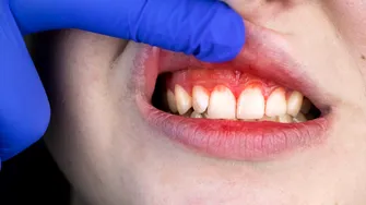De ce sângerează gingiile: cauze frecvente și când trebuie să mergi la stomatolog
