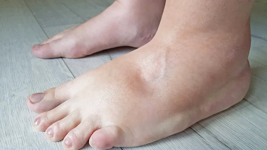 Corpul tău pare umflat fără motiv: adevărul despre retenția de apă