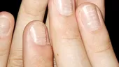 Ce sunt liniile albe de pe unghii?