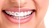 13 mituri despre aparatul dentar! cu Dr. Catrinel Banu, medic dentist specialist