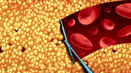 Ce să mănânci atunci când ai colesterolul mărit? Alimentul pe care îl poți consuma chiar și la conservă