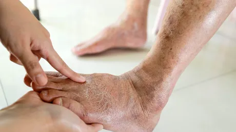 ​Picioare umflate, urină spumoasă și oboseală persistentă? Semne care pot indica probleme renale la persoanele cu diabet sau hipertensiune