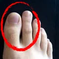Ai al doilea deget al piciorului mai lung decât degetul mare? Este sau nu o anomalie?