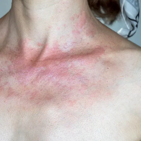 Femeie mutilată din cauza cremelor de față: „M-am trezit desfigurată!” Ce ingredient conținea produsul care a băgat-o în spital