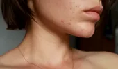 Alimente pe care să le eviți dacă iei acest tratament pentru acnee. Riști complicații severe