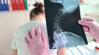 Cele 4 semne vizibile care pot indica scolioza la copii. Afecțiunea apare frecvent între 10 și 15 ani