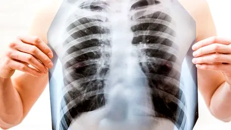 Pandemia amână tratamentele bolnavilor de cancer pulmonar