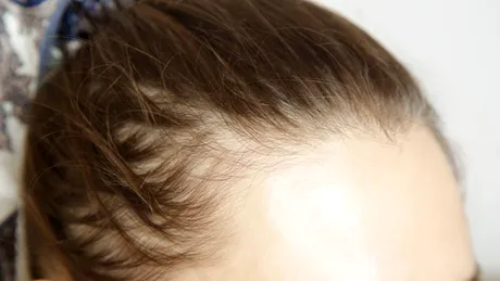 Slăbești, dar îți cade părul? Ce legătură au injecțiile pentru slăbit cu alopecia