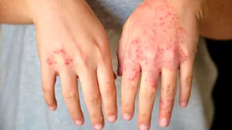Semnul că tratamentul tău pentru psoriazis nu mai funcționează. Medicii spun când trebuie schimbat