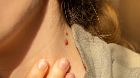 O femeie a învins melanomul după ce și-a scos 100 de alunițe