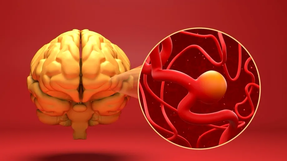 (P) Anevrismul cerebral: tratament minim invaziv prin neuroradiologie intervențională