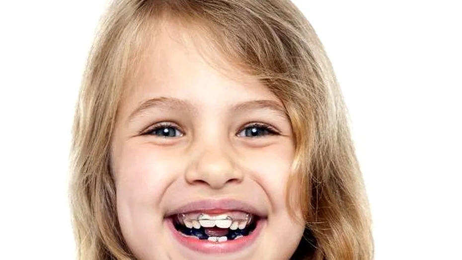 Dinţii înghesuiţi la copii – cauze şi tratament