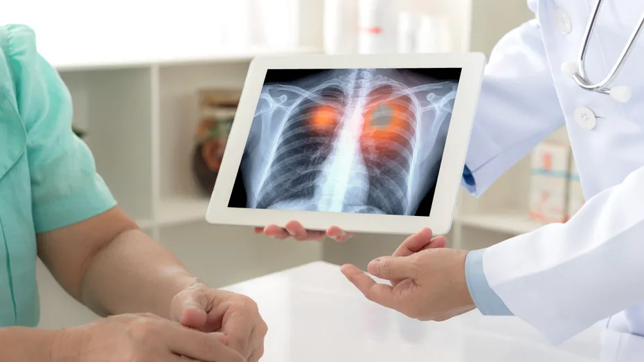 Cum este tratat cancerul bronhopulmonar?