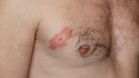 ATENȚIE la căpușe! Medic: Leacurile băbești le fac să intre și mai mult în piele