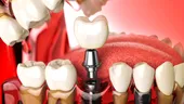 Ce trebuie să știe pacientul care a pierdut mai mulți dinți și are nevoie de tratament cu implanturi dentare și adiție de os