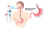 ESG (micșorarea de stomac pe cale endoscopică): alternativa endoscopică pentru slăbire, fără operații invazive