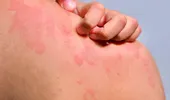 Urticaria cronică spontană: cât durează, de ce apare și când trebuie să mergi la medic