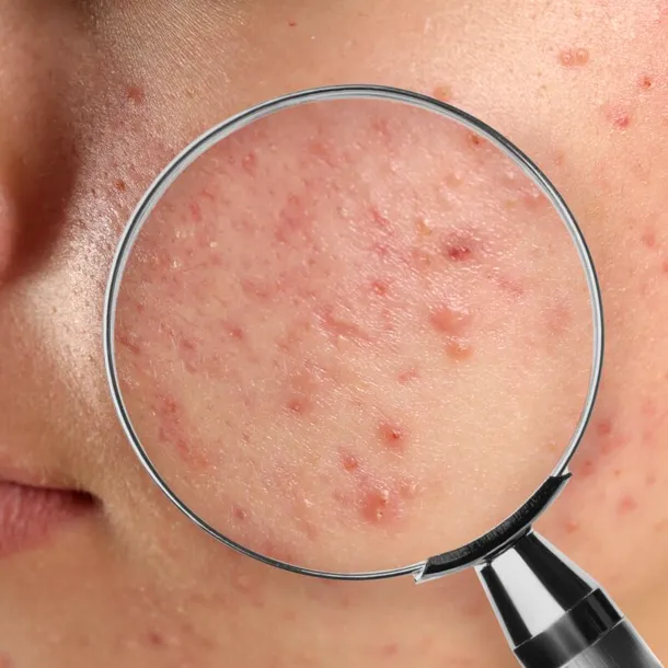 Acnee juvenilă? Află cum îți poți calma pielea cu ingrediente naturale