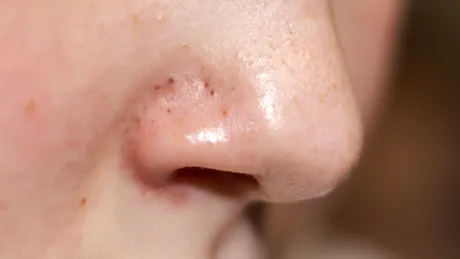 Tratamentul natural de 7 lei împotriva punctelor negre. Scapi de imperfecțiuni cu acest exfoliant preparat acasă