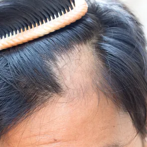 Părul tău merită mai mult: Dr. Diana Savu explică tot ce trebuie să știi despre alopecie și prevenție