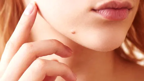 Aluniţa: cauze, simptome, tratament