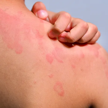 Urticaria: ce o declanșează și cum o ții sub control cu remedii naturiste