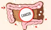 4 boli care cresc riscul de cancer de colon. Ce analize se fac preventiv