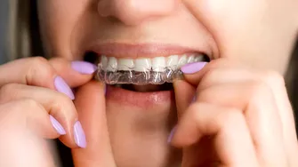 Ortodonția în 2025 – nu mai e ce era: fără brackets, fără metal, fără vizite lunare. Simplu, dar eficient, în același timp