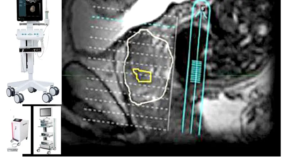 Fusion biopsy - cea mai avansată metodă de diagnostic pentru cancerul de prostată