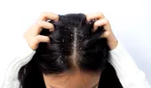 Cum poți scăpa de mătreață în mod natural. Obiceiurile care pot reduce exfolierea scalpului și preveni reapariția ei