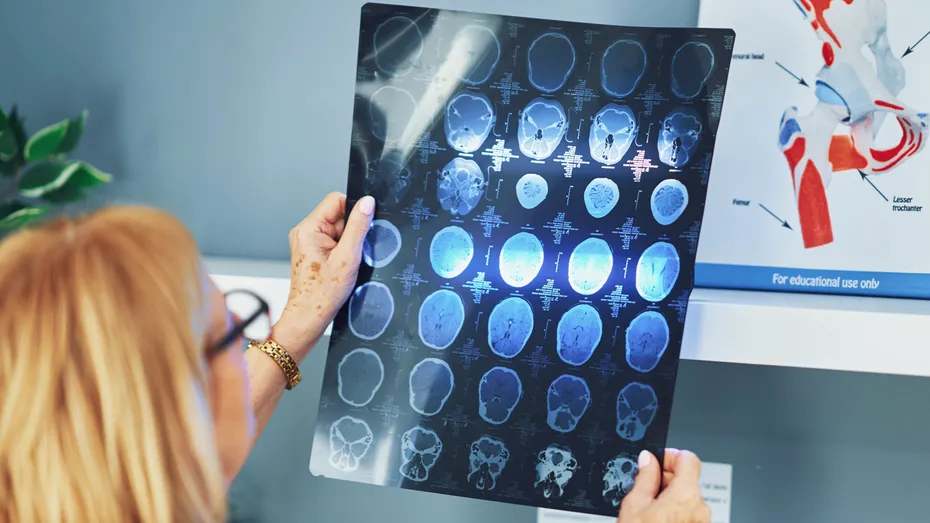 Avertisment pentru pacienții cu demență! Medicamentul care crește riscul de AVC