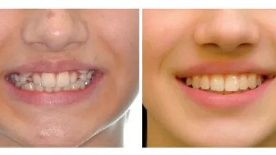 Caninii ectopici (caninii de vampir): ce sunt, cum îi recunoști și care sunt opțiunile de tratament