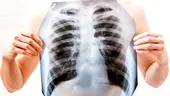 Este nevoie de mai multă atenţie acordată bolnavilor de cancer pulmonar!