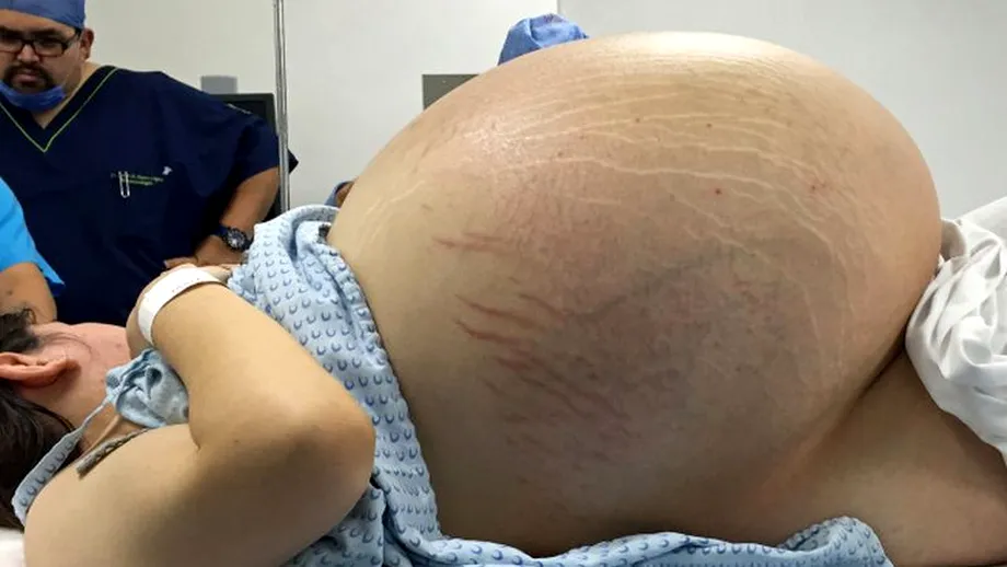 Chist ovarian de 32 de kilograme, înlăturat cu succes de o echipă de medici din Mexic