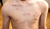 Rujeola, mai aproape de un tratament? Cercetătorii au identificat anticorpi care neutralizează virusul