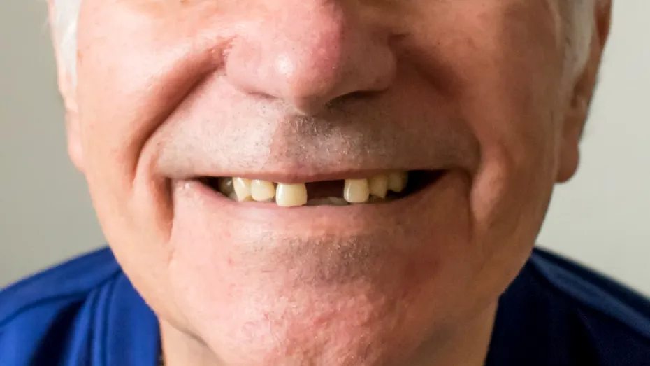 Implant sau punte dentară - care este cea mai bună soluție dacă ai pierdut un dinte?