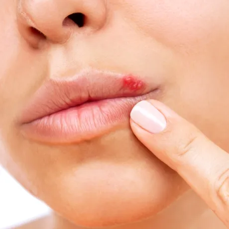 Cum să scapi de herpes repede. Remediul natural care îl face să dispară peste noapte