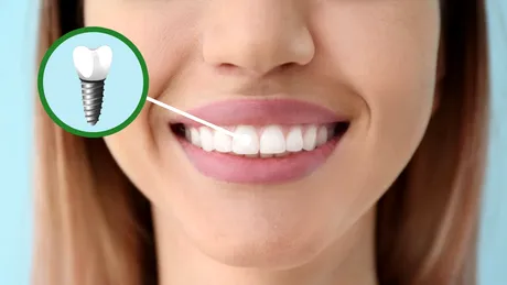 Ce opțiuni avem atunci când pierdem un dinte sau o măsea? Implant sau regenerare?