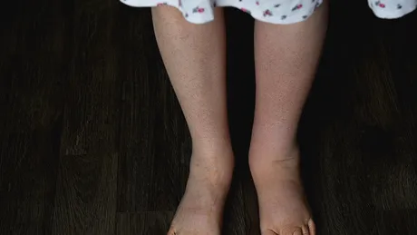 Cum elimini retenția de lichide prin alimentație. De ce apare senzația de balonare, după fiecare masă