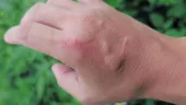 Mușcătura de furnică: remediul simplu care calmează rapid durerea și mâncărimea