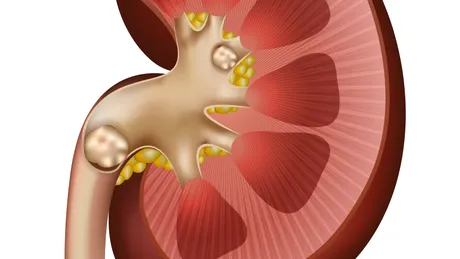 Nefrocalcinoza: cauze, simptome, tratament