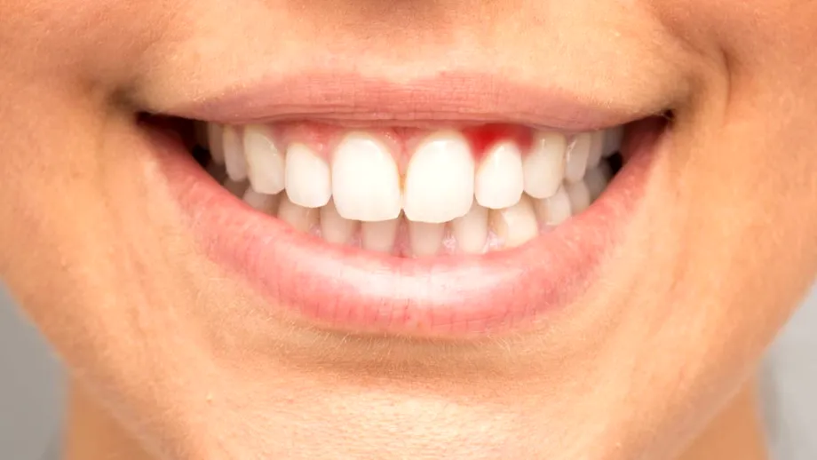 Ce carențe ai dacă îți sângerează gingiile sau îți apar afte