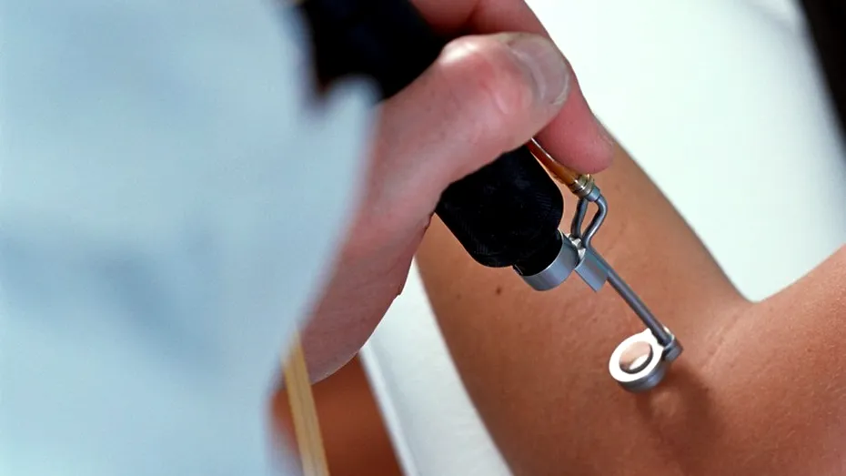 Epilarea definitivă cu laser: o creştere cu 25% în rândul bărbaţilor din România